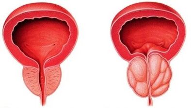 Prostate saine et enflammée avec prostatite
